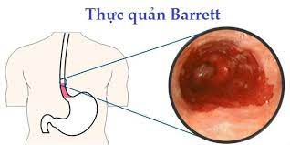 Barrett thực quản. Nguyên nhân, triệu chứng, chẩn đoán và điều trị