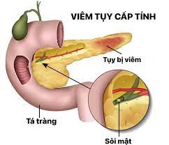 Viêm tụy cấp: Nguyên nhân, triệu chứng, chẩn đoán và điều trị