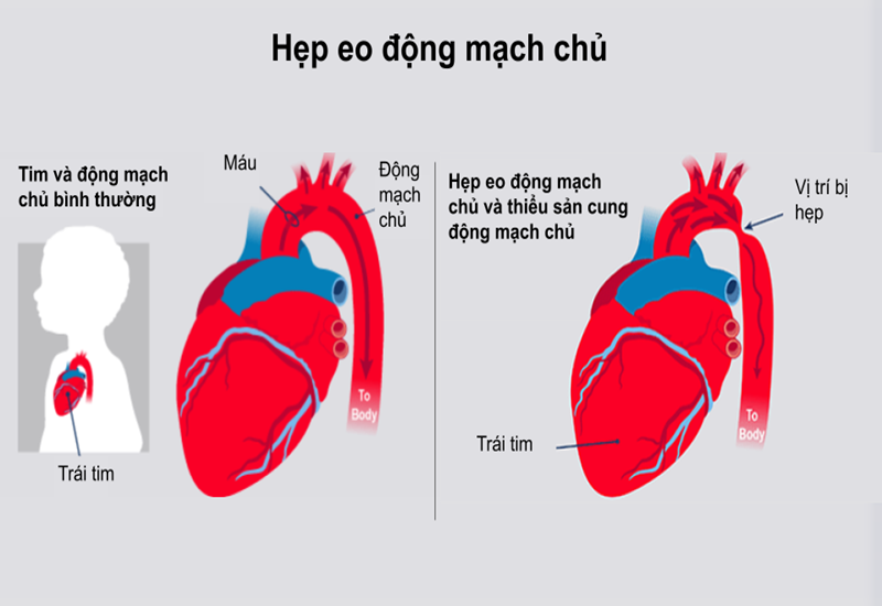 Hẹp eo động mạch chủ: Nguyên nhân, triệu chứng, chẩn đoán và điều trị