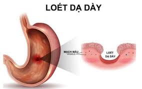 Viêm loét dạ dày: Nguyên nhân, triệu chứng, chẩn đoán và điều trị