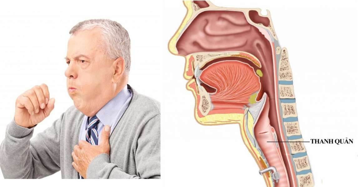 Liệt cơ mở thanh quản: Nguyên nhân, triệu chứng, chẩn đoán và điều trị