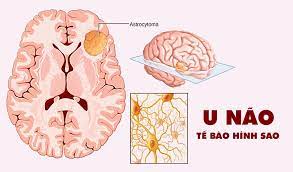 U não ở trẻ em: Nguyên nhân, triệu chứng, chẩn đoán và điều trị