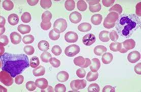 Babesia (nhiễm trùng do Babesia). Nguyên nhân, triệu chứng, chẩn đoán và điều trị