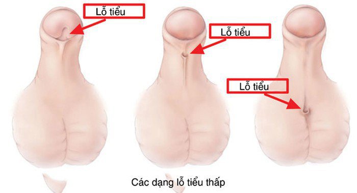 Lỗ tiểu đóng thấp: Nguyên nhân, triệu chứng, chẩn đoán và điều trị