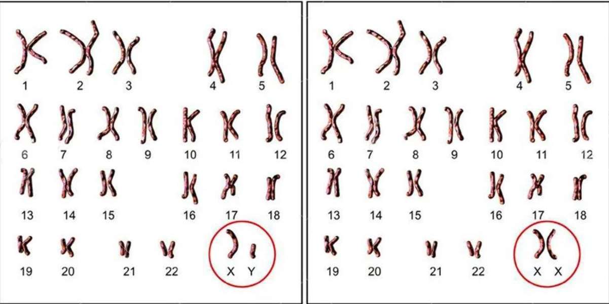 Hội chứng XYY: Nguyên nhân, triệu chứng, chẩn đoán và điều tr