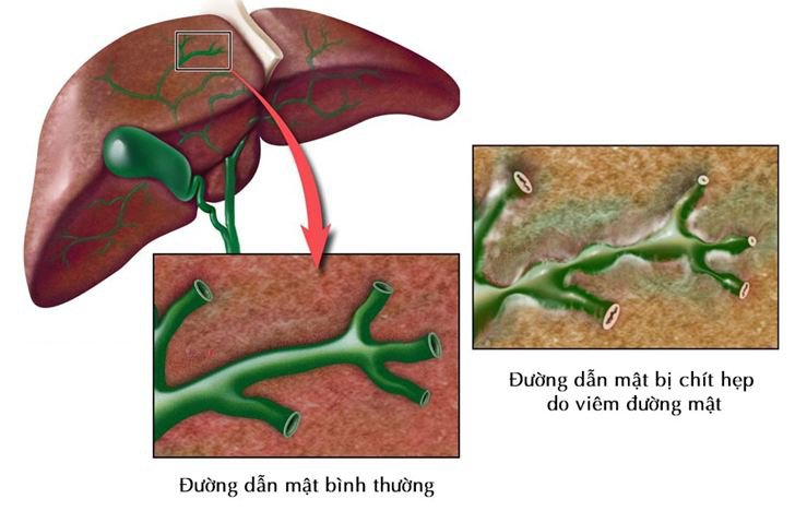 Hẹp đường mật bẩm sinh: Nguyên nhân, triệu chứng, chẩn đoán và điều trị