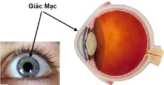 Loét giác mạc: Nguyên nhân, triệu chứng, chẩn đoán và điều trị