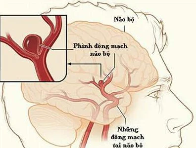 Thoát vị não: Nguyên nhân, triệu chứng, chẩn đoán và điều trị