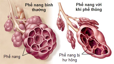 Khí phế thũng: Nguyên nhân, triệu chứng, chẩn đoán và điều trị