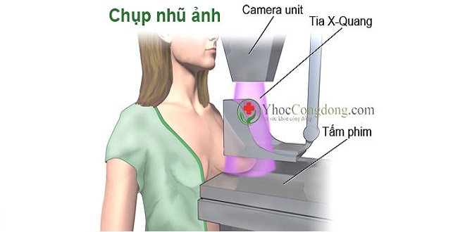 Các bệnh tuyến vú lành tính