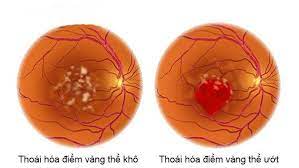 Thoái hóa hoàng điểm tuổi già