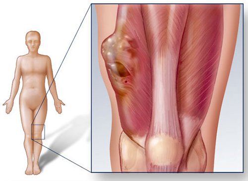 Ung thư xương: Nguyên nhân, triệu chứng, chẩn đoán và điều trị